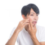 ニキビ跡のしみ